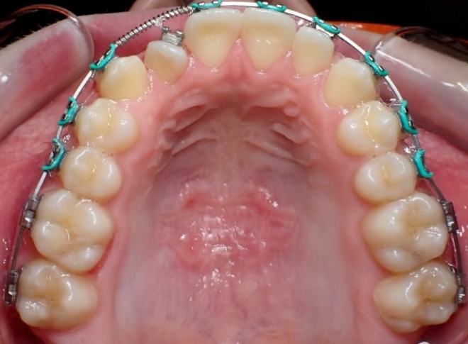 MSE (Maxillary Skelatal Expansion)