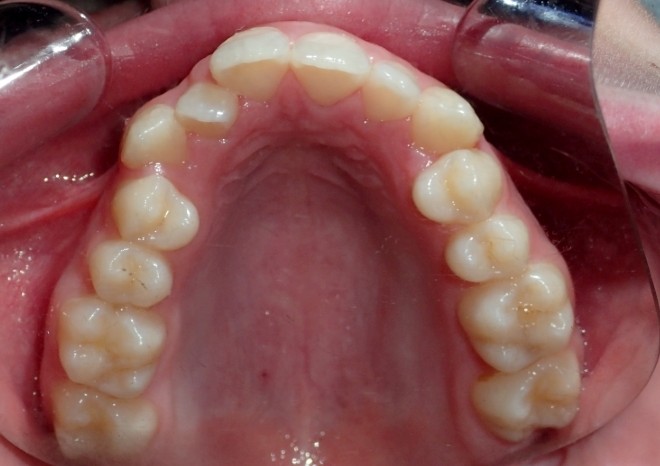 MSE (Maxillary Skelatal Expansion)