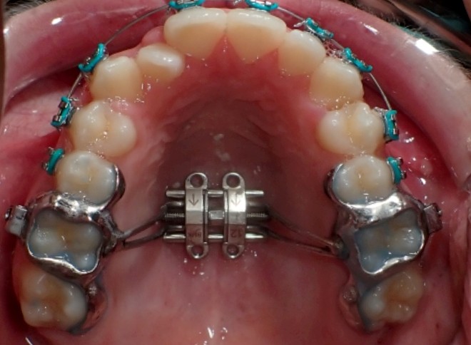 MSE (Maxillary Skelatal Expansion)