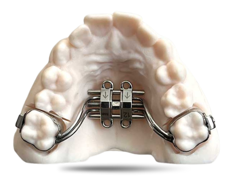 MSE (Maxillary Skelatal Expansion)